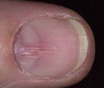 Ониходистрофия на ногах лечение thumbnail