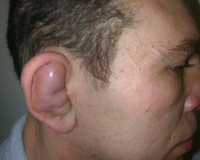 Гематома на ушной раковине thumbnail