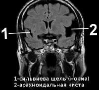 Кисты в головном мозге головная боль лечение thumbnail