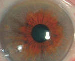 Как развивается катаракта при синдроме фукса thumbnail