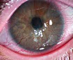 Вросшие сосуды глаз лечение thumbnail