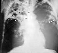 Отличие цирротического туберкулеза от цирроза легкого thumbnail