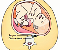 Синдром сдавливания нижней полой вены у беременных thumbnail