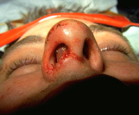 Травмы носа: кровотечение, отек, ушиб thumbnail