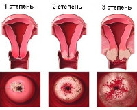 Рак шейки матки во время беременности thumbnail