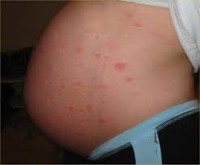 Зудящий дерматит при беременности thumbnail