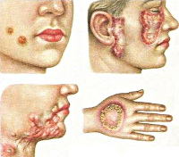 Лечение туберкулеза кожи лица thumbnail