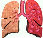 Сухой кашель при бронхоэктатической болезни thumbnail