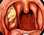 Ангина симановского плаута венсана дифференциальная диагностика thumbnail
