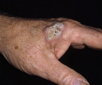 Плоскоклеточный рак кожи руки thumbnail