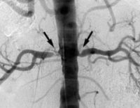Атеросклероз почечных артерий дифференциальная диагностика thumbnail