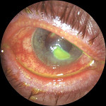Язва роговицы глаза операция человека thumbnail