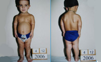 Короткие конечности у ребенка синдром thumbnail
