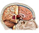 Синдромы при опухолях головного мозга thumbnail