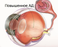 Ангиоспазм сетчатки глаза это thumbnail
