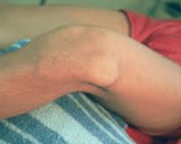 Вывих протеза коленного сустава thumbnail