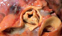 Аортальный клапанный стеноз и инфаркт миокарда thumbnail