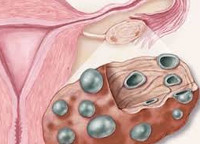 Поликистоз яичников и синдром поликистоза яичников thumbnail