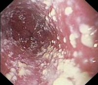 Заболевания женских органов молочница thumbnail
