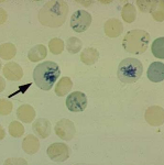 Ретикулоцитоз и появление полихроматофилов характерны для анемии thumbnail