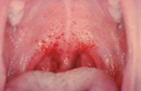 Геморрагической лихорадка с почечным синдромом глпс thumbnail