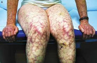 Герпетическая инфекция и антифосфолипидный синдром thumbnail