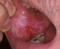 Изменения в полости рта при лучевой терапии thumbnail