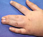 Синдактилия пальцев ног лечение thumbnail