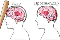 Осложнения после травм головного мозга (сотрясение, ушиб головного мозга) thumbnail