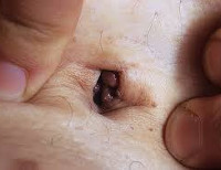 При эндометриозе может быть дерматит thumbnail