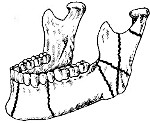 Перелом нижней челюсти в области тела thumbnail