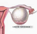 Дермоидная киста яичника этиология thumbnail