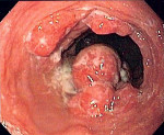 Аденогенный рак желудка после резекции прогноз на рецидив thumbnail