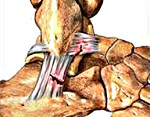 Растяжение травматическое повреждение связок сустава thumbnail