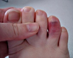 Ушибы пальцев ног у детей thumbnail