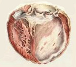 Атеросклеротический кардиосклероз гипертоническая болезнь 1 ст thumbnail