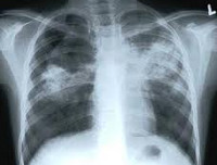 Симптомы туберкулеза у ребенка 4 года thumbnail