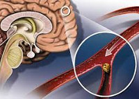 Атеросклероз сосудов мозга диагностика и лечение thumbnail