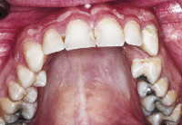 Вывихи переломы зубов альвеолярных отростков thumbnail