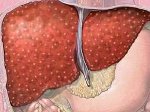 Билиарный цирроз печени стадии thumbnail