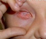 Субатрофия глазного яблока помутнение роговицы thumbnail