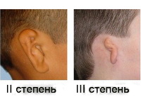 Отсутствие ушной раковины генетический синдром thumbnail