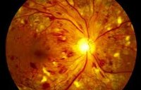 Помутнения сетчатки ретинопатии возникают вследствие thumbnail