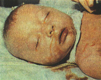 Вирусные гепатиты у детей первого года жизни thumbnail