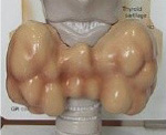 Абсцесс щитовидной железы лечение thumbnail