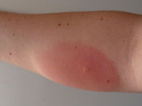 Аллергический дерматит на укус thumbnail