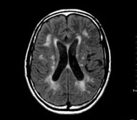 Дисциркуляторная энцефалопатия при церебральном атеросклерозе thumbnail