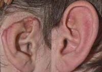 Синдром при котором деформированы уши thumbnail