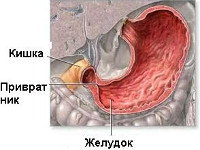 Симптомы стенозирующей язвы пилорического отдела желудка thumbnail