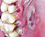 Местное лечение стоматита венсана thumbnail